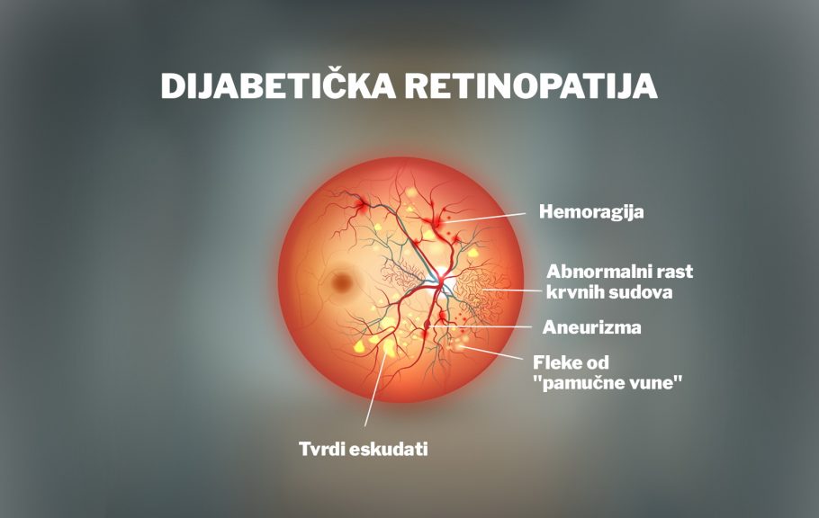 dijabetička retinopatija- slepilo- vid