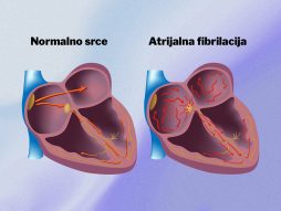 atrijalna fibrilacija-nepravilan rad srca