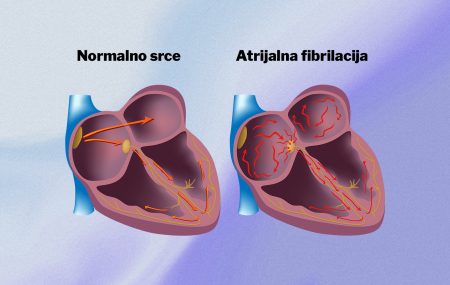atrijalna fibrilacija-nepravilan rad srca