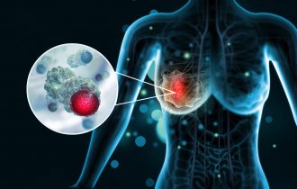 Luminalni tip B rak dojke prate povećani recidivi bolesti – kako se otkriva i leči
