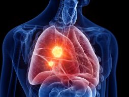 rak pluća- zašto nepušači dobiju rak