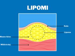 lipom - tumor vezivnog tkiva