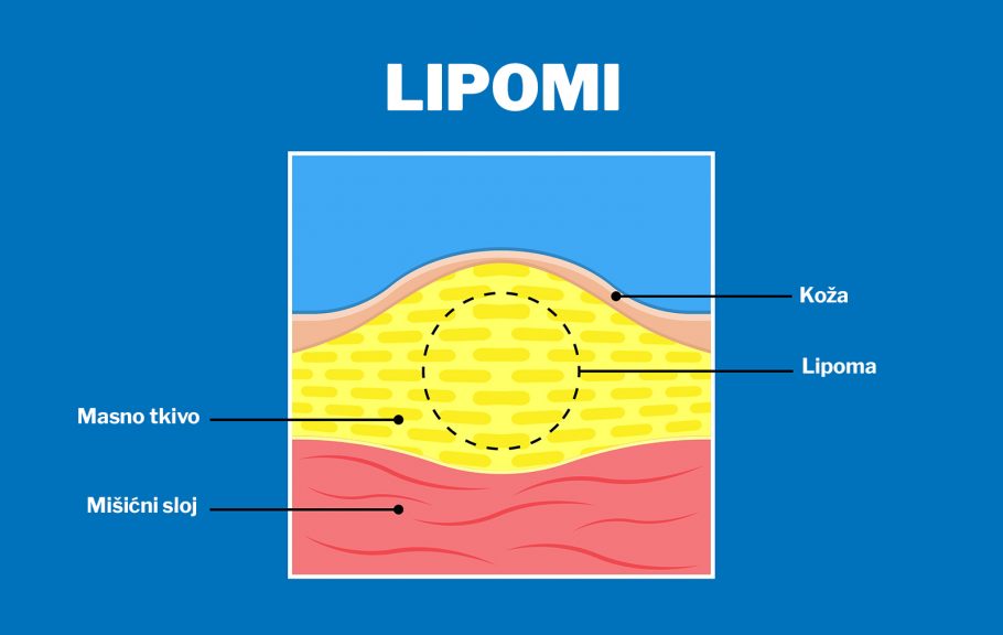 lipom - tumor vezivnog tkiva