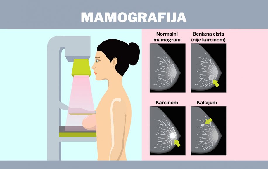 mamografija