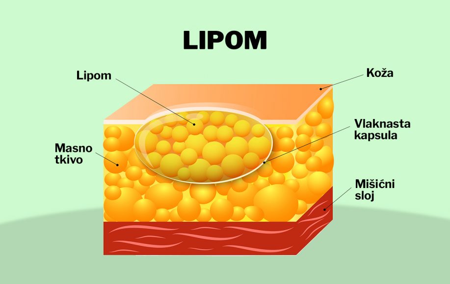 lipom