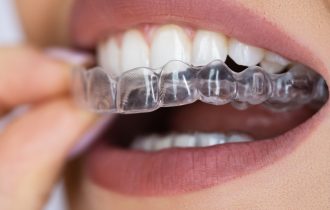 Škrgutanje zubima je nesvesno: Šta se tada dešava sa desnima i vilicom
