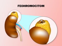 feohromocitom