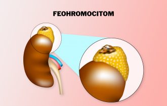 Feohromocitom je benigni tumor nadbubrežne žlezde, na koje promene treba odreagovati