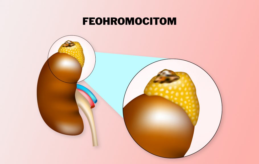 feohromocitom