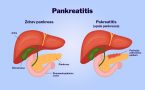 Pankreas pankreatitis