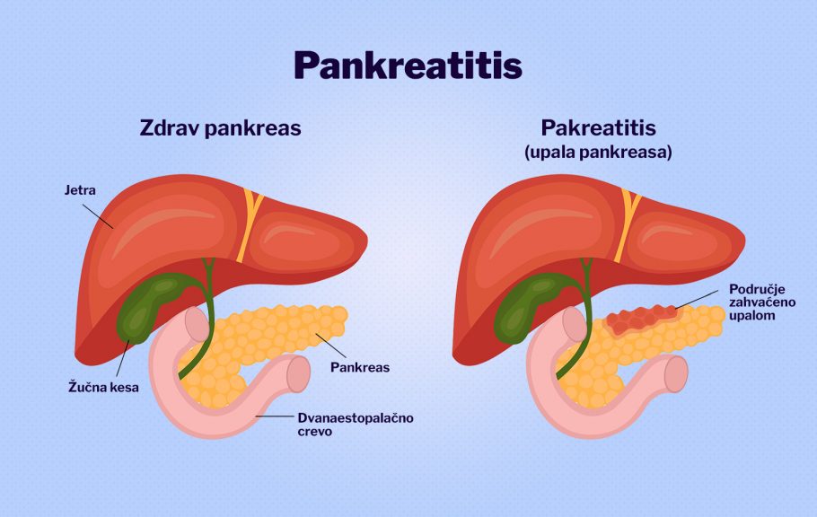 Pankreas pankreatitis