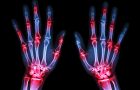 Novi lek za reumatoidni artritis