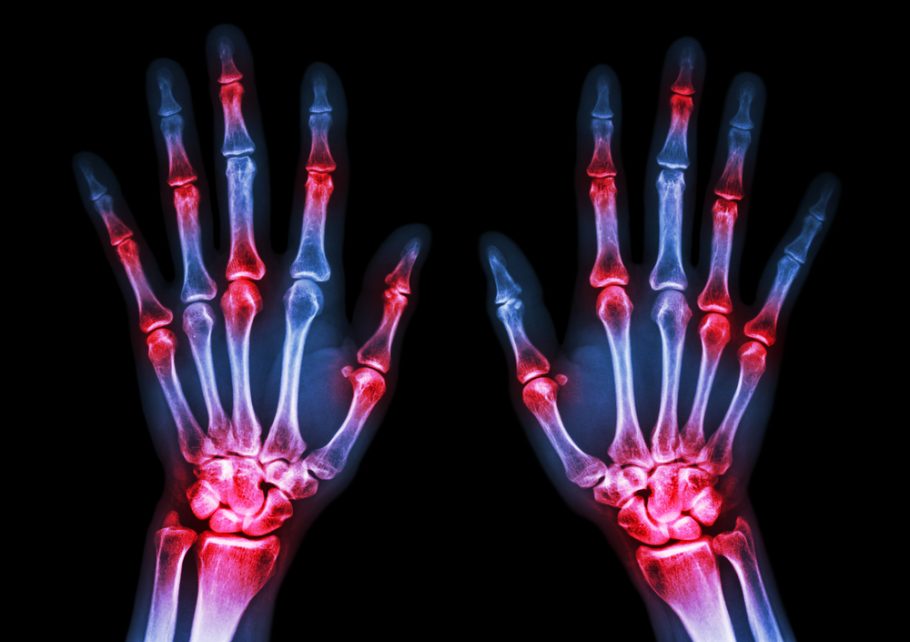 Novi lek za reumatoidni artritis