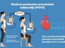 Sindrom posturalne ortostatske tahikardije (POTS)