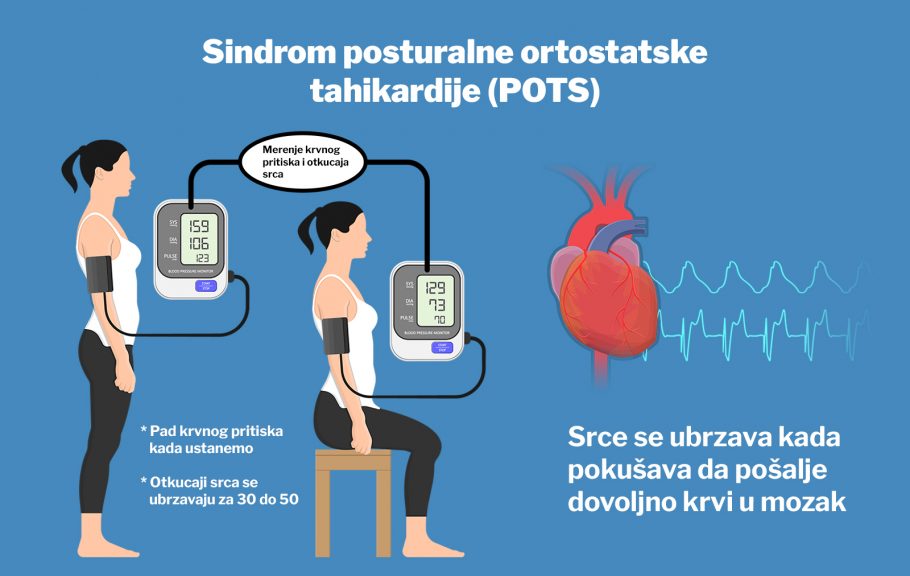 Sindrom posturalne ortostatske tahikardije (POTS)