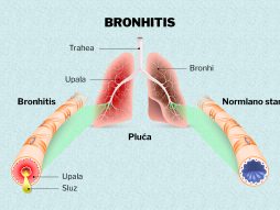 Bronhitis