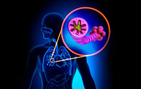Hronična opstruktivna bolest pluća