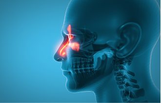 Rak nosa i sinusa može da bude „zamaskiran“ u prehladu ili sinusitis