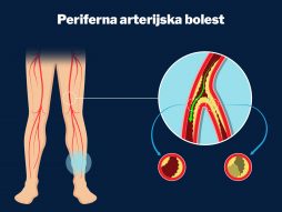 bolest perifernih arterija