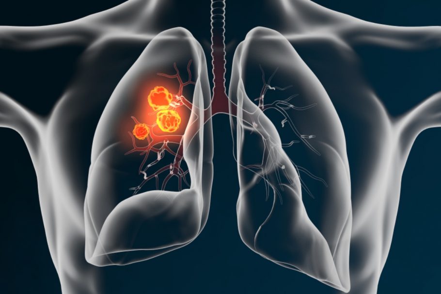 rak pluća