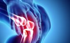 Simptomi koiji ukazuju na artritis kolena