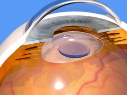 Očni implantat