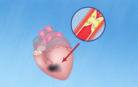 Rizik od srčane smrti
