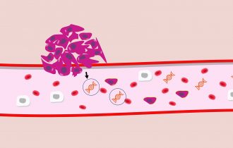 Nova vrsta analize krvi otkriva da li se rak ponovo vratio 