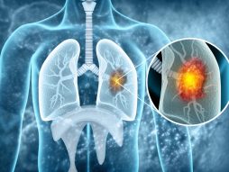 neoperabilni rak pluća