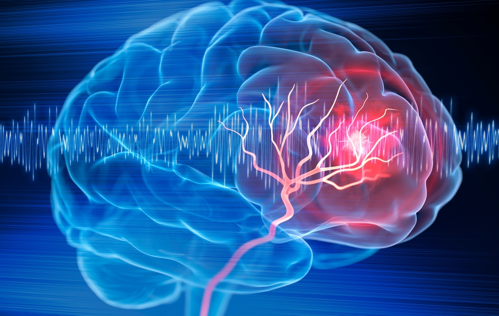 moždani udar može najaviti 7 simptoma koji traju samo nekoliko minuta
