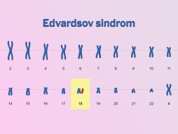 Edvardsov sindrom