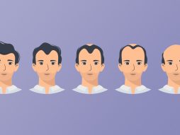 gubitak kose kod muškaraca