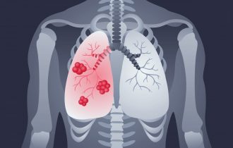 Saveti za olakšavanje simptoma kod obolelih od raka pluća