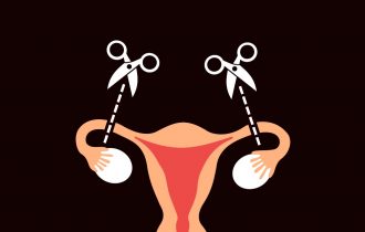 Uklanjanje jajovoda, kako bi se izbegao rak jajnika, preporučuje se nekim ženama, kažu stručnjaci
