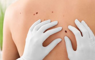 Rizik od raka kože veći je kod ljudi sa određenim kožnim oboljenjem