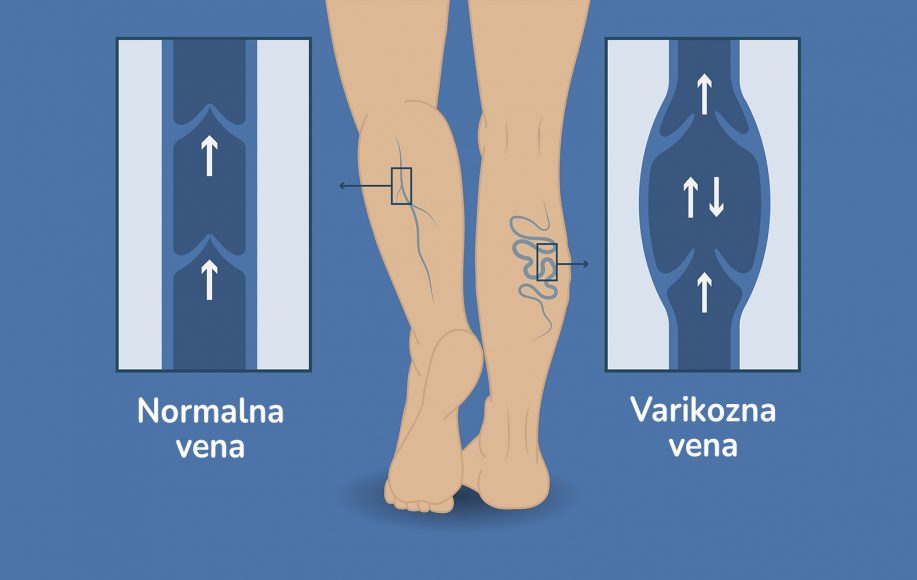 Površinska Upala Vena - Koliko Je Opasan Bol Koji Se Javlja Kada Se ...