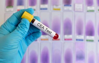 Kada se radi i šta otkriva CEA test ili karcinoembrionalni antigen