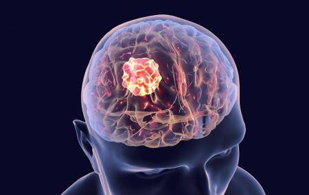 tumor na mozgu