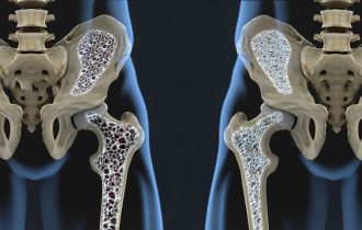 Osteoporoza i lekovi, kada je potrebno na izvesno vreme obustaviti primenu bisfosfonata