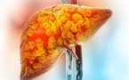 bolest masne jetre