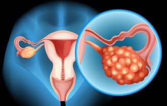 Ovi simptomi upozoravaju na rak jajnika, najsmrtonosniji ginekološki karcinom