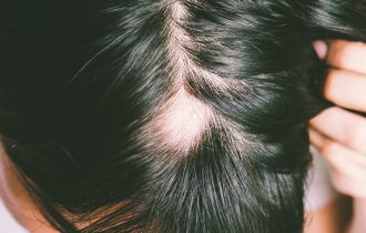 Razvijen novi tretman protiv gubitka kose koji izaziva alopecija