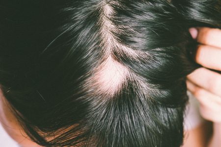 alopecija