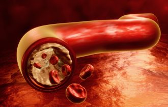 Kako bolest perifernih arterija utiče na naše telo