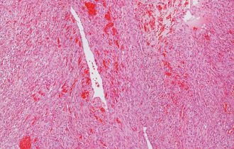 Kako prepoznati angiosarkom, redak tumor mekog tkiva