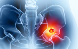Rak prostate: Šta kada metastazira na kosti