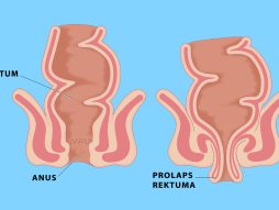 Prolaps rektuma