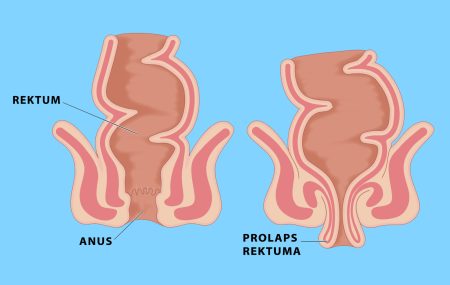 Prolaps rektuma