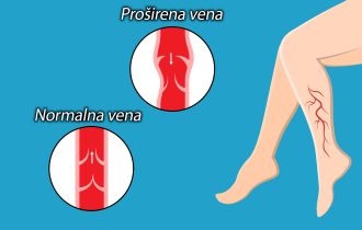 Proširene vene i bol u nogama uglavnom su rezultat jedne loše navike, upozoravaju vaskularni hirurzi