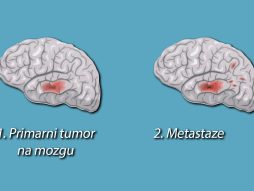 Metastaze na mozgu